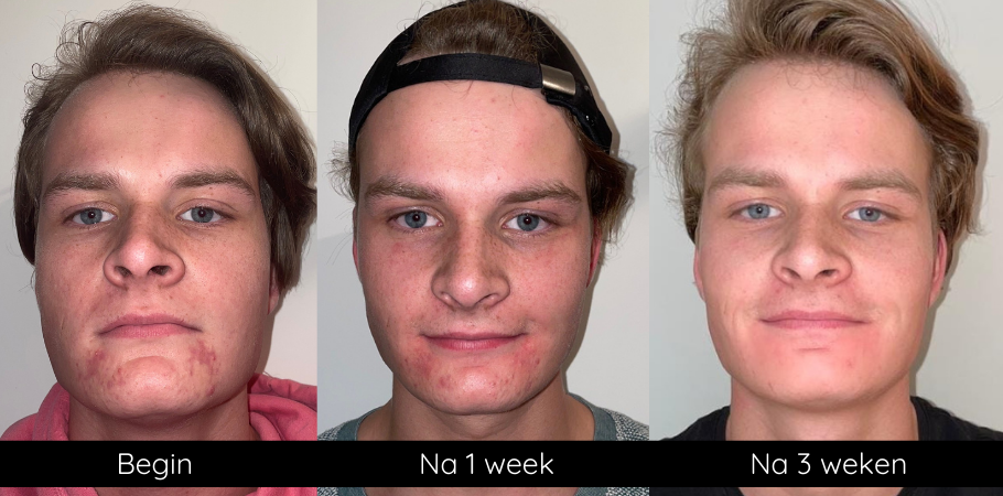 Anti-acne kit - Afbeelding 5